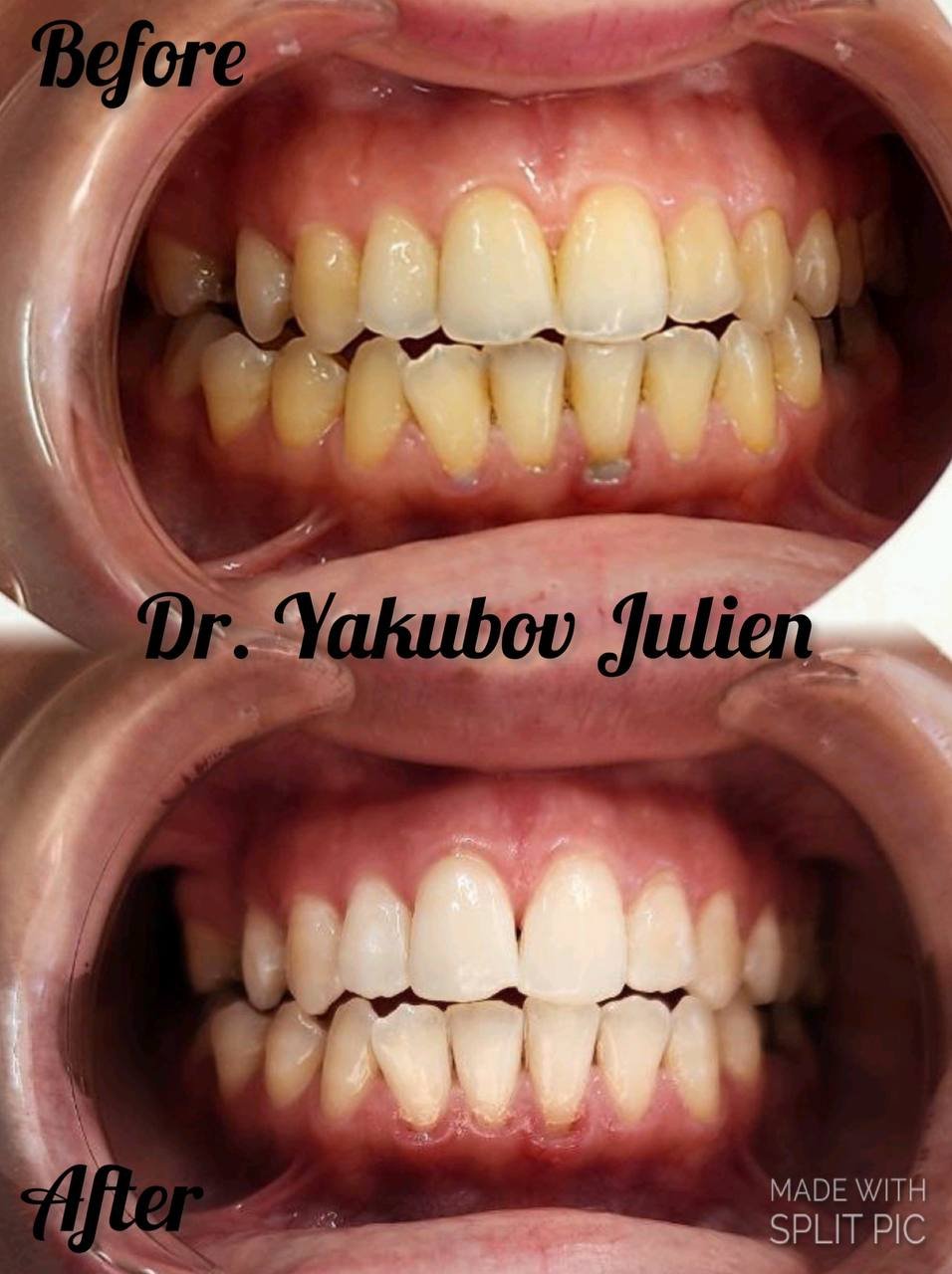 Отбеливание