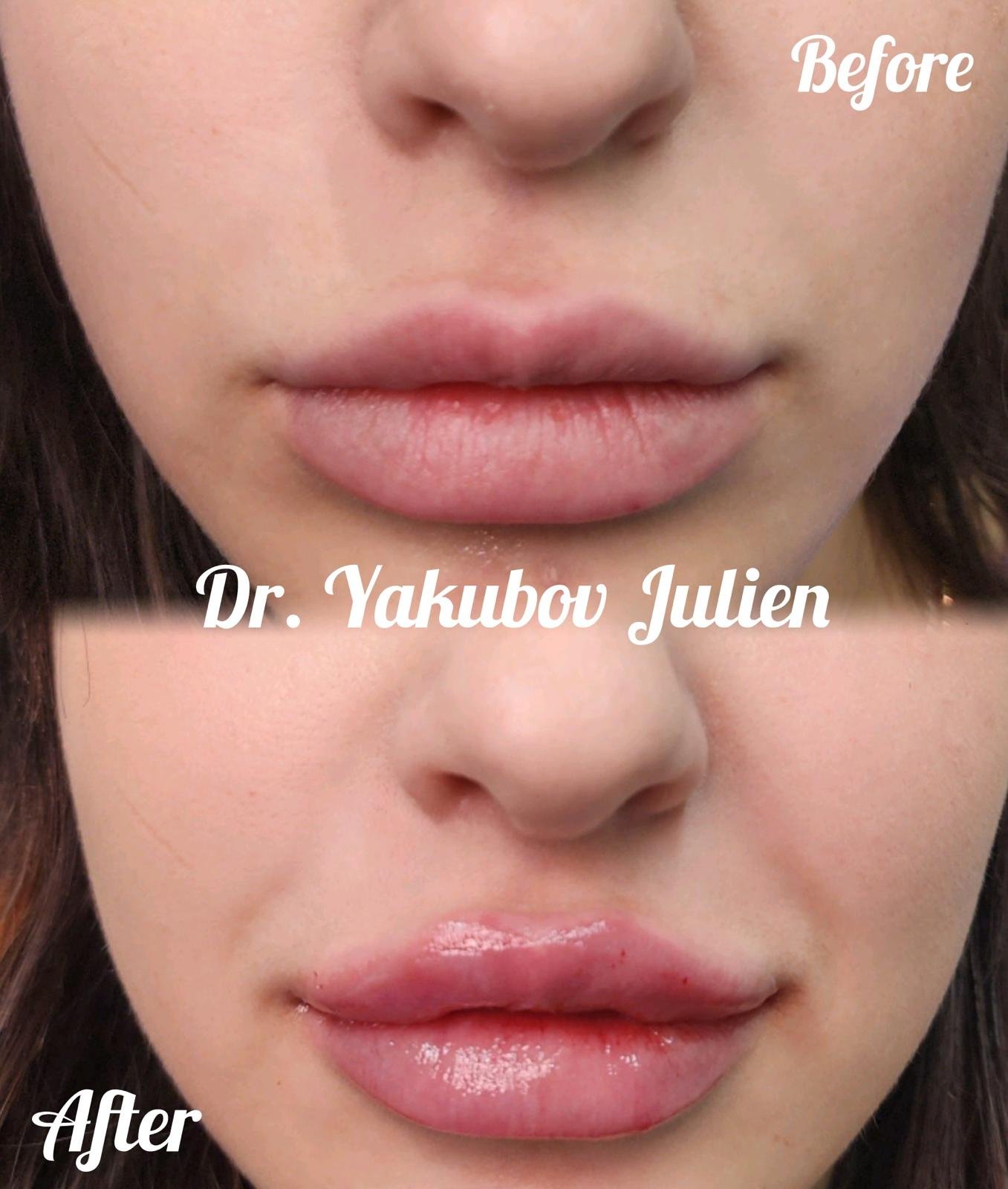 гиалурон - 4