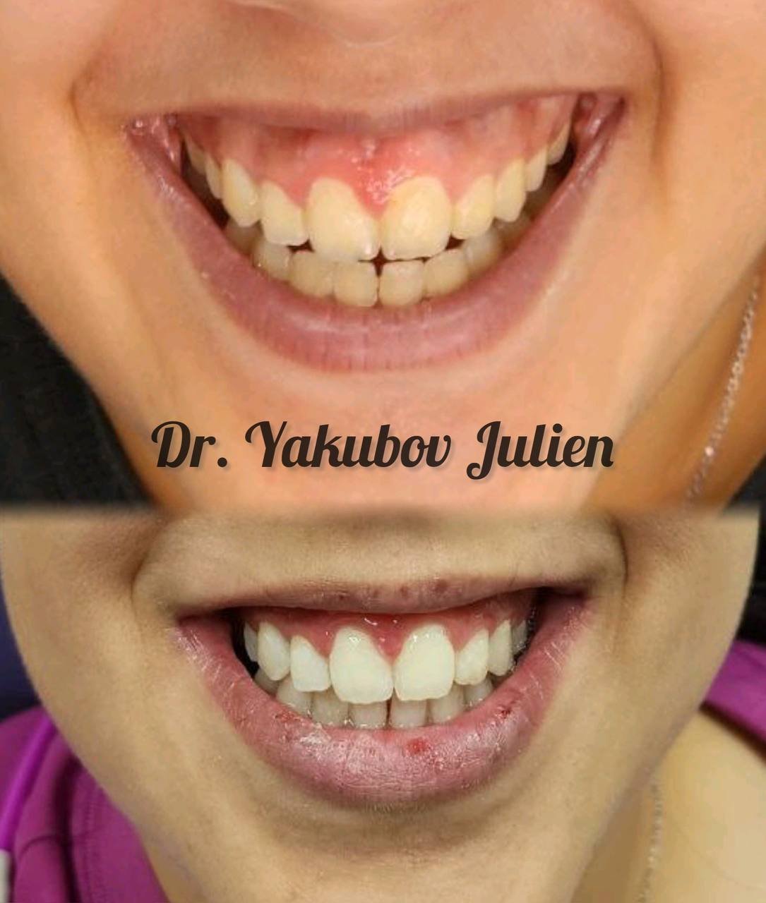 отбеливание - 2