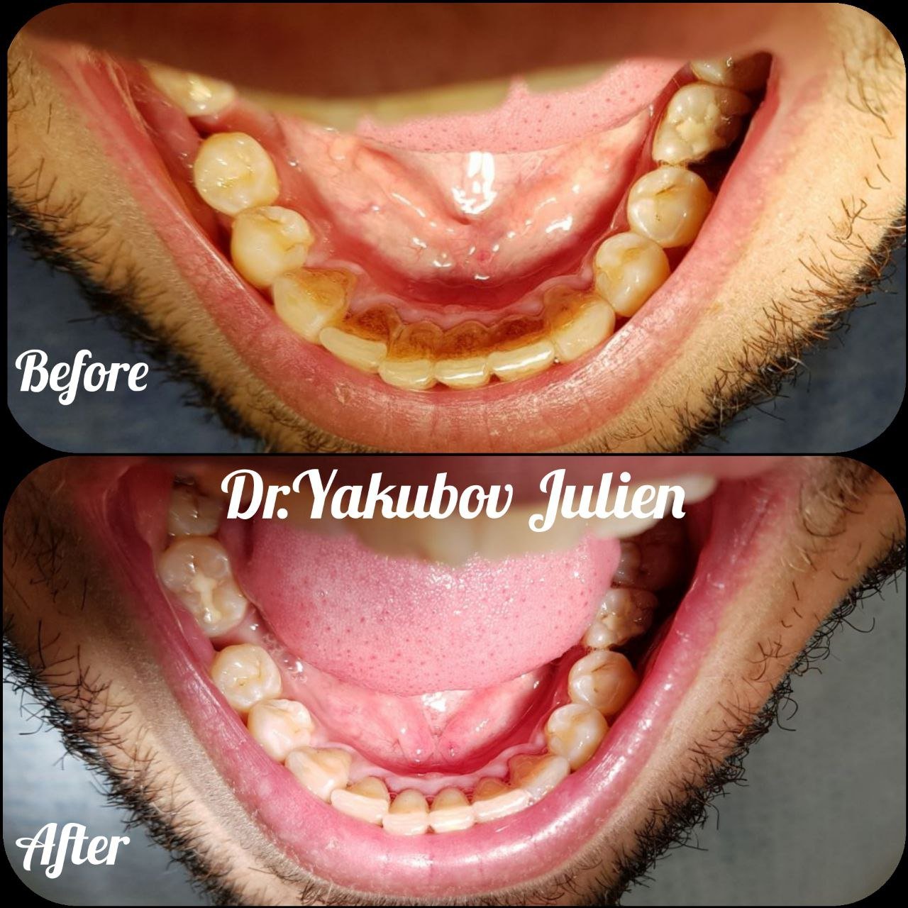 терапия - чистка 2