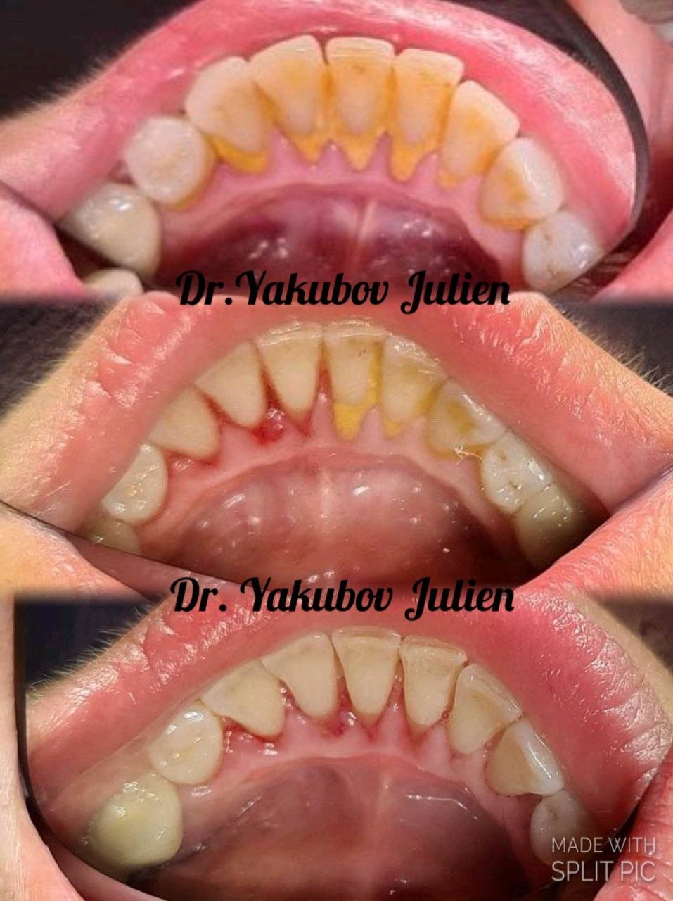 терапия - чистка